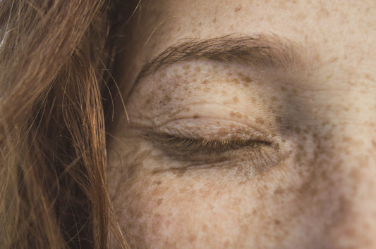 Melasma vs hyperpigmentation comparison showing facial pigmentation and uneven skin tone